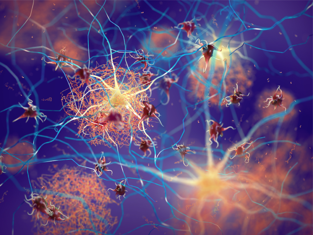 Amyloid plaques forming Amyloid plaques forming